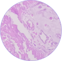 Adenocarcinoma