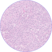 Carcinoma de células escamosas (CCE)
