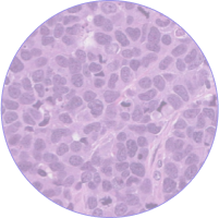 Carcinoma (indiferenciado) de células grandes